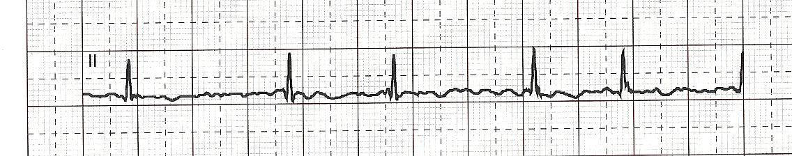 ECG FA