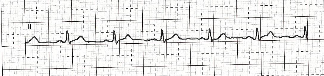 ECG normale