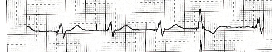 ECG – Pacemaker